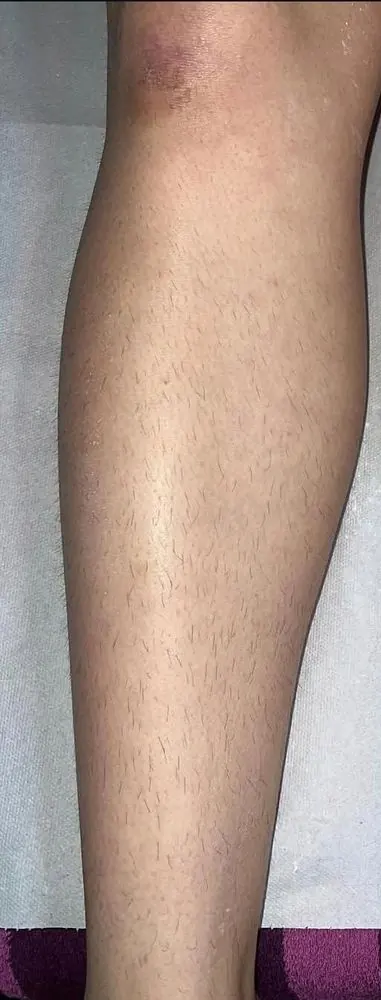Pre depilacije